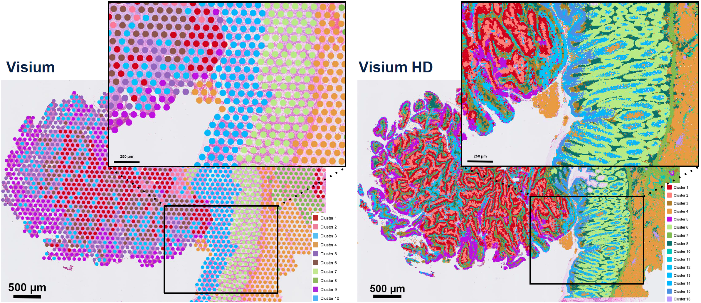 spatial analysis of colorectal cancer comparing Visium with Visium HD resolution